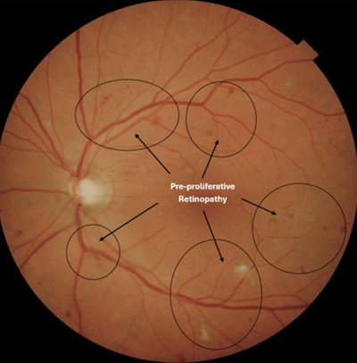 Pre-proliferative Retinopathy 