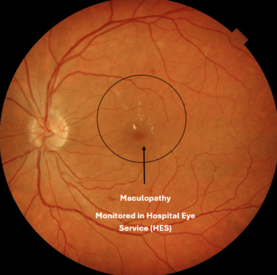 Diabetic Maculopathy 