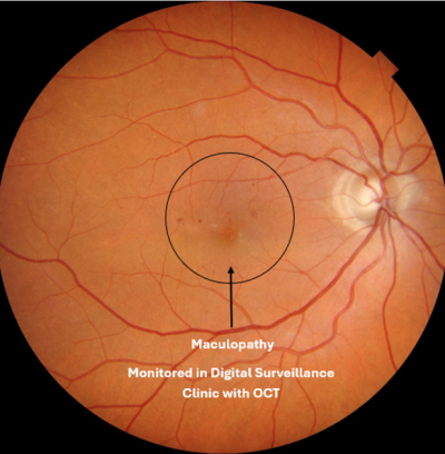 Diabetic Maculopathy