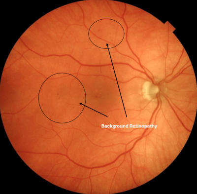 Background Retinopathy 