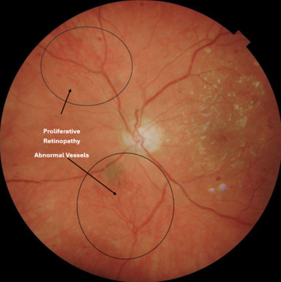 Proliferative Diabetic Retinopathy 