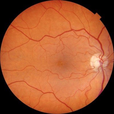 No Diabetic Retinopathy - No Eye Changes 